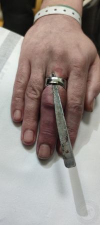 OPRAVDU SE STALO: Z ošklivě nateklého prstu hasiči dostávali prstýnek skoro hodinu