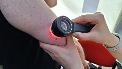 Nechte si vyšetřit pigmentové skvrny a znaménka, chystají se další Dny melanomu